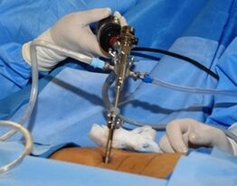Chirurgische Behandlung der lumbalen Osteochondrose