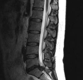 Diagnoseoptionen für die lumbale Osteochondrose