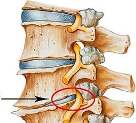 Warum ist die lumbale Osteochondrose