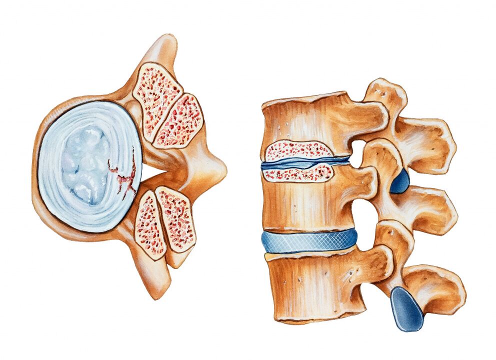 Osteochondrose der Gebärmutterhalsregion führt zur Zerstörung von Krebsscheiben im Bereich der Bandscheibe