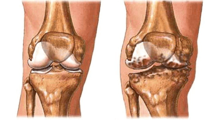 Gesunde Artikulation und Arthrose des Kniegelenks
