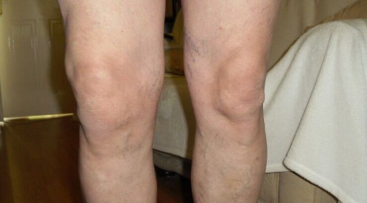 Manifestationen von Arthrose des Kniegelenks