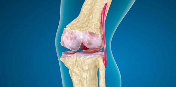 Schädigung des Kniegelenks durch Arthrose