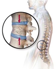 Osteoporose verursacht Rückenschmerzen im unteren Rücken